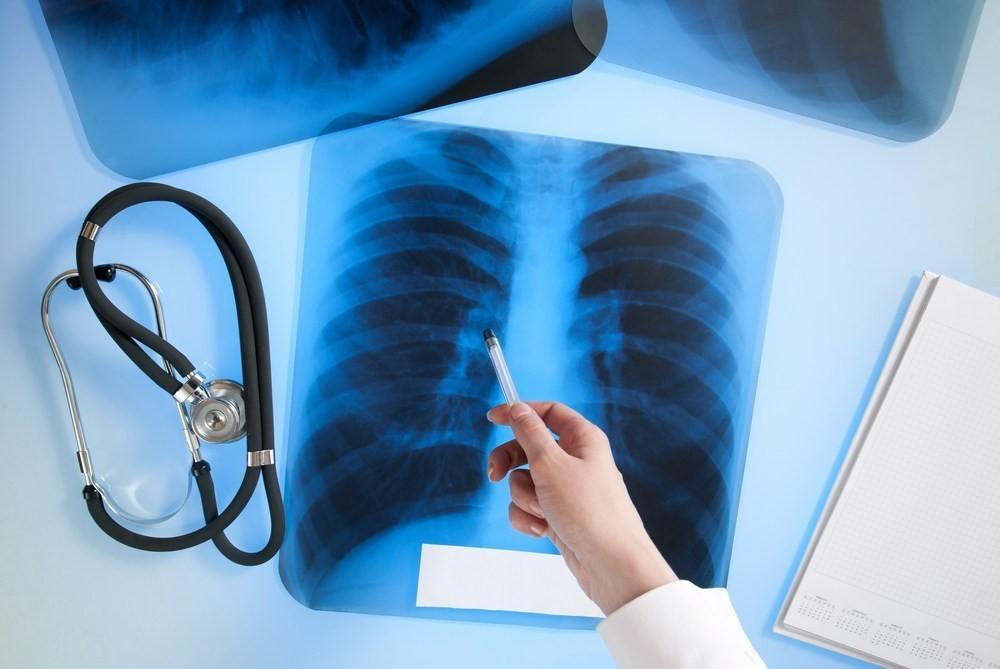 Number of tuberculosis patients revealed