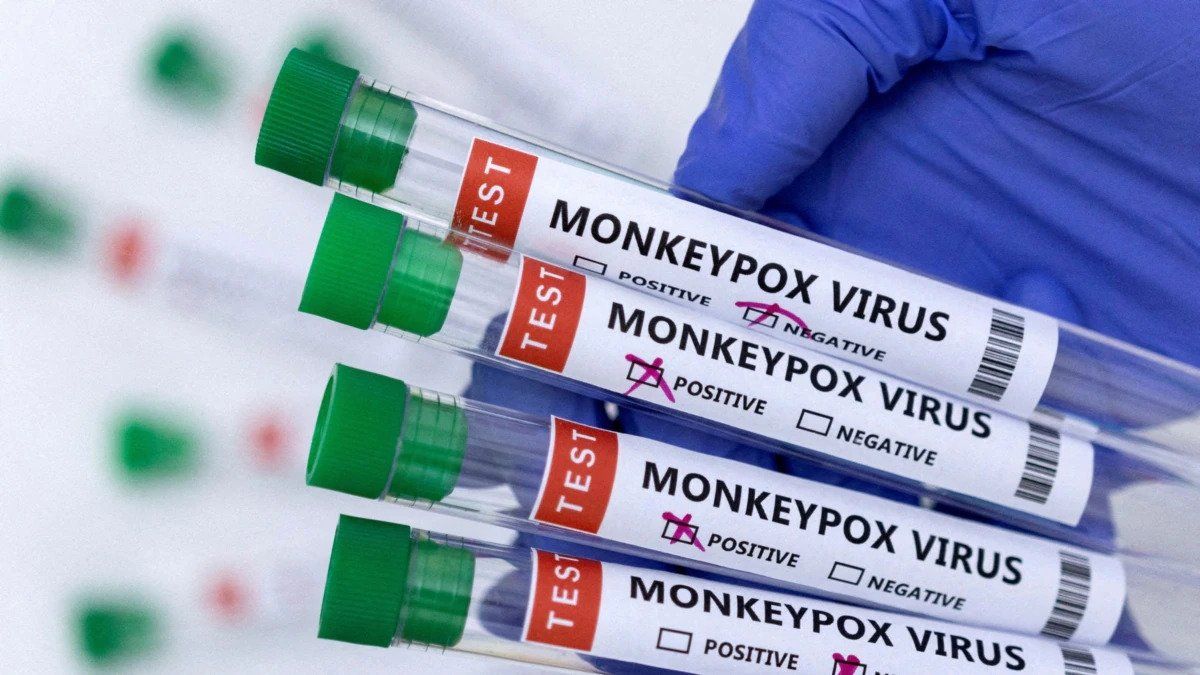 Monkeypox test results of two Azerbaijani citizens prove negative