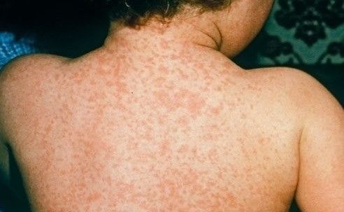Kyrgyzstan registers 708 cases of measles since beginning of this year