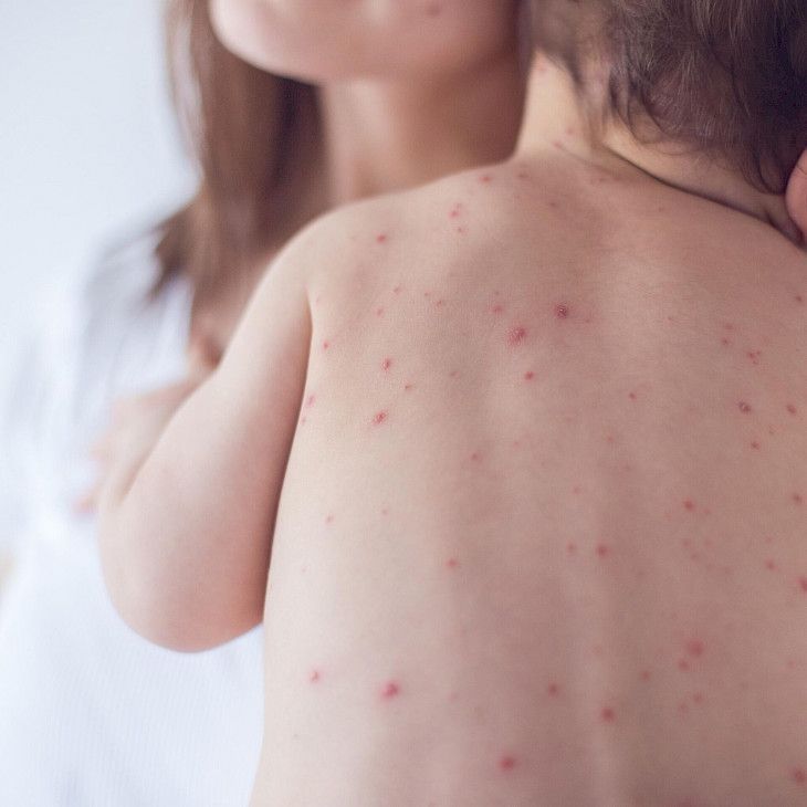 Number of infected with measles in Kyrgyzstan exceeds 5,000 people
