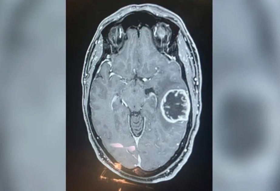 New test develop in UK that can detect brain tumors in matter of hours